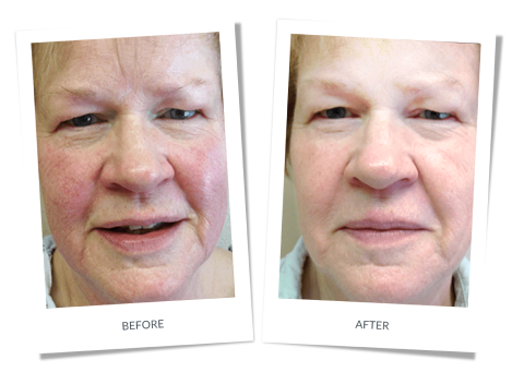 Rosacea Banner
