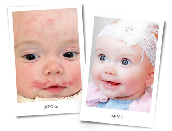 Eczema