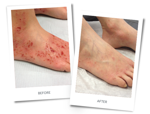 Foot Dermatitis