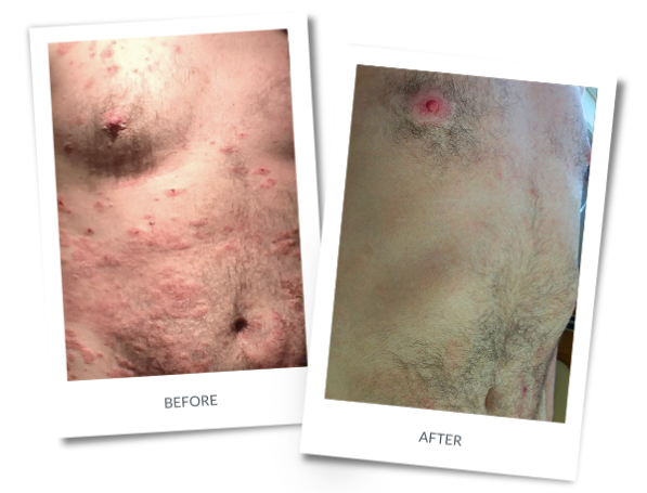 Severe Atopic Dermatitis