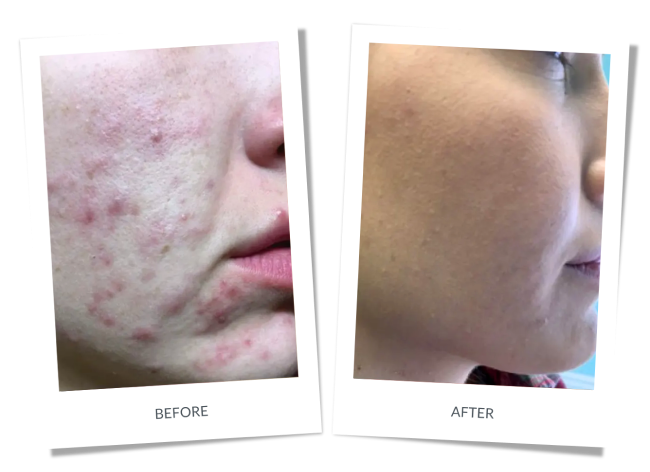 >Acne Telemedicine Visit Banner