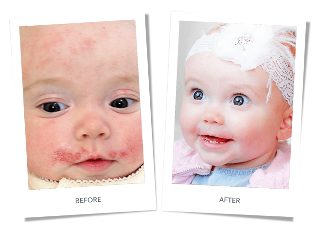 Eczema img