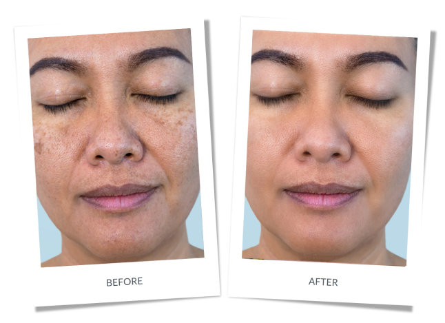 Melasma or Hyperpigmentation Banner