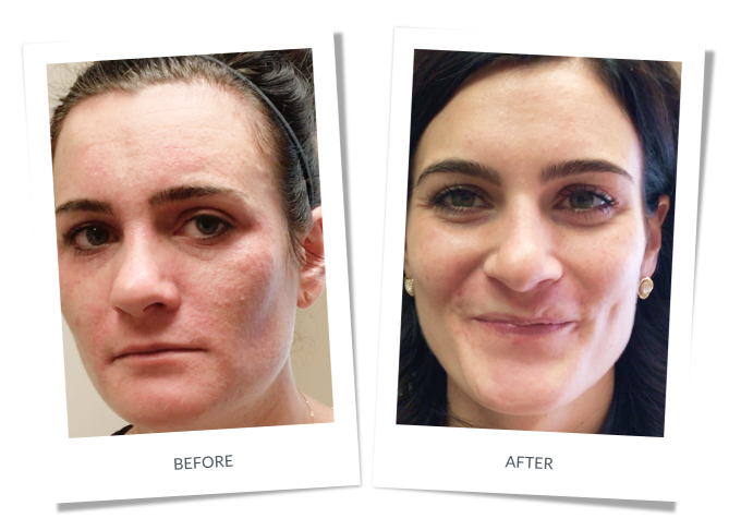 Perioral Dermatitis Banner