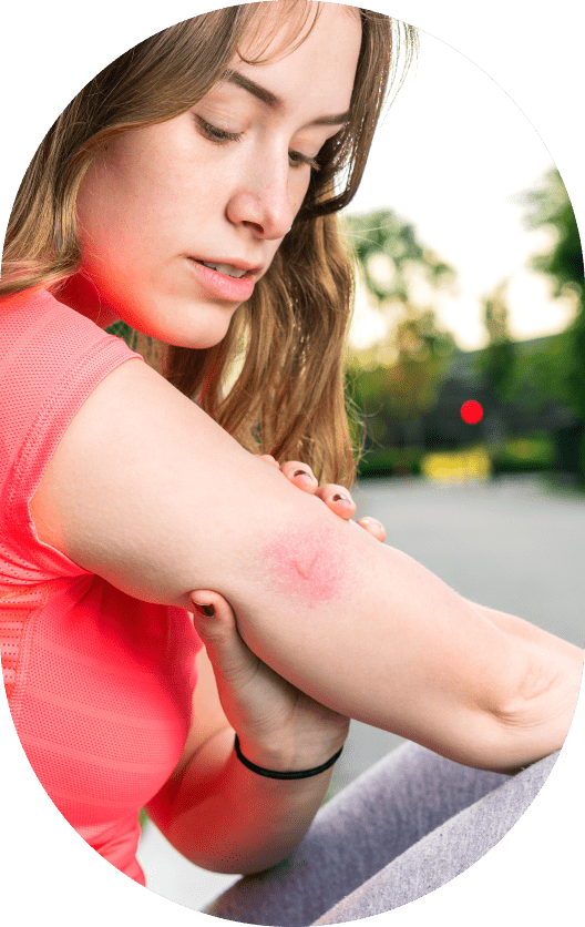 Insect Bites and Stings