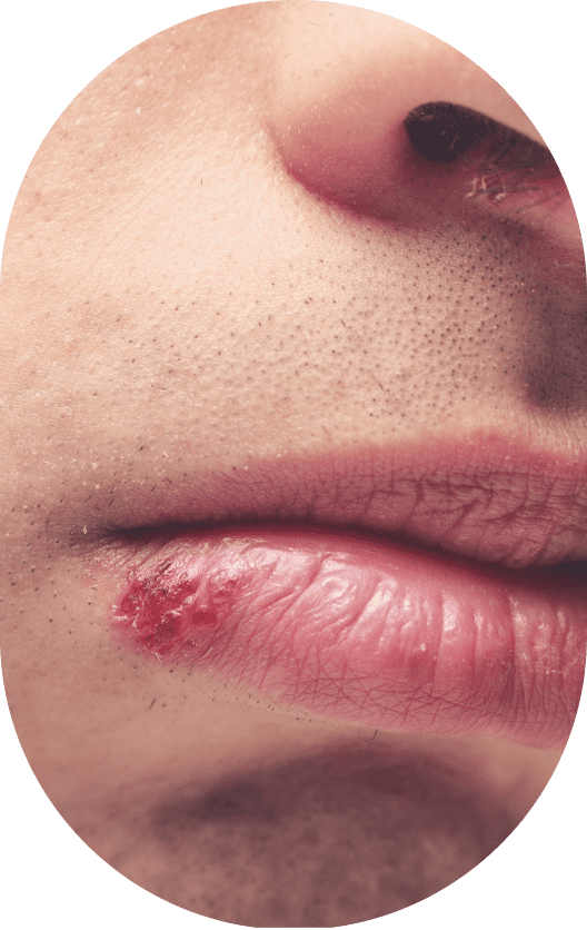 Cold Sore