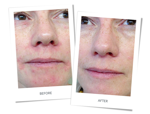 Perioral and Periocular Dermatitis