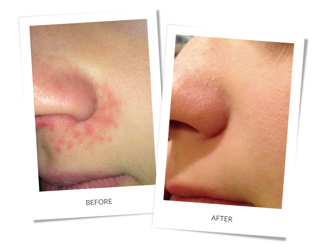 Mild Perioral Dermatitis Around the Nose