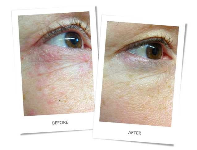 Periocular Dermatitis