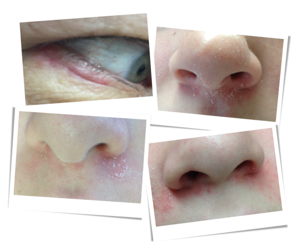 Perioral Dermatitis